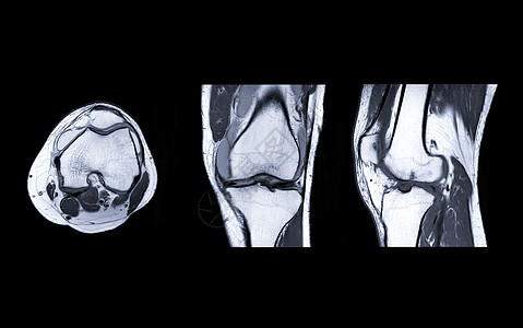 MRI Knee 联合三观点核磁共振膝盖软骨骨骼髌骨扫描电波运动射线诊断图片