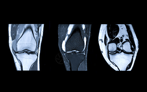 MRI Knee 联合三观点扫描器射线保健卫生药品骨科髌骨股骨磁铁创伤图片