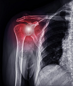 X射线肩膀联合诊断 肩膀交叉失调图片