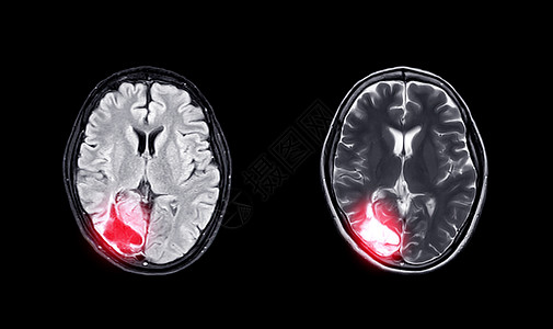 对比磁共振脑Axial T2W光和T2W视图 以显示肝炎病图片