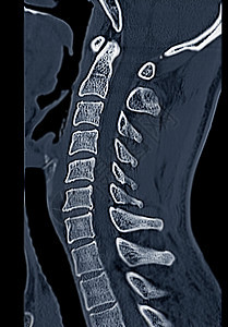 比较CT C脊椎或宫颈脊椎3D成像和人形图象扫描颈椎病病人技术考试诊断伤害骨科颅骨脊柱图片