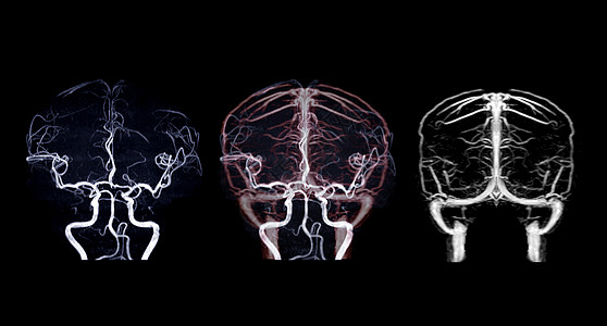 MRA脑和MRV脑诊断静脉中风速度动脉流动血管谐振放射科鼻窦图片