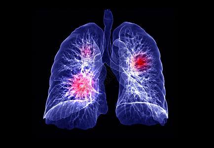 CT 肺3d 肝脏成象器官结节屏幕病人胸椎心脏病学扫描诊断心血管哮喘背景图片