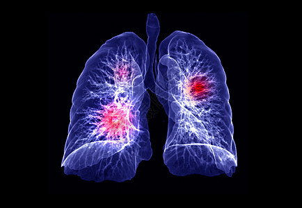 CT 肺3d 肝脏成象器官结节屏幕病人胸椎心脏病学扫描诊断心血管哮喘图片