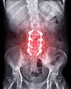 L -S脊椎AP 邮报行动Lumbar板和螺丝图片