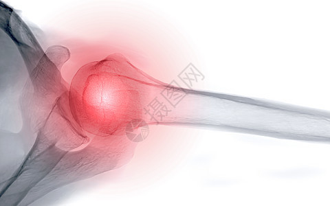 X射线肩膀合肩穿梭式观察 以诊断肩臂关节骨折创伤解剖学骨科疾病器官症状放射科骨骼肩胛骨断臂图片
