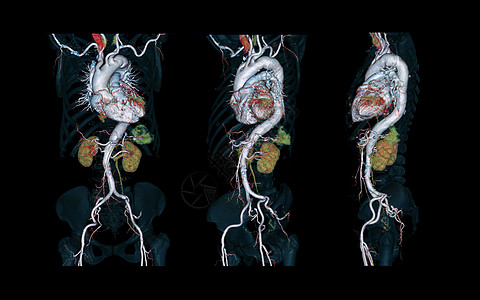 CTA 整个 aorta 3D 以黑色背景显示图像 用于检测动脉动脉瘤诊断射线插图断层照相图表心室放射科监控技术图片