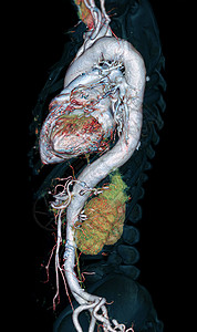 CTA 整个 aorta 3D 以黑色背景显示图像 用于检测动脉动脉瘤图表血管照相医院心室科学临床药品放射科主动脉图片