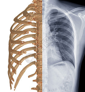 比较CT Chest 3D投影和Chest X光片图片