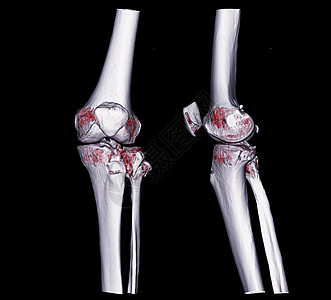 CCT 膝盖3D 拍摄图像AP和侧面视图图片