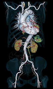 CTA 整个 aorta 3D 以黑色背景显示图像 用于检测动脉动脉瘤科学心脏病学临床血管动脉药品射线插图照相断层图片