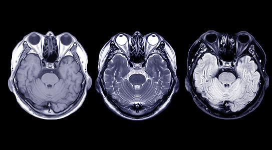 比较大脑的 MRI 轴心 T1 T2和 T2 Flair图片