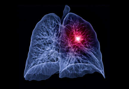 CT 肺3d 肝脏成象肋骨电影癌症肺炎解剖学哮喘电脑疾病结核科学图片