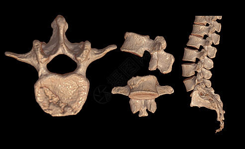 CT 腰椎或 LS 脊柱 3D 渲染图像正面 背面和侧面视图ct脊椎扫描器医院光盘神经椎间疝气3d背痛图片