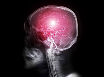 人体头骨横向视图与MRA脑图相融合的Skull X射线图像图片