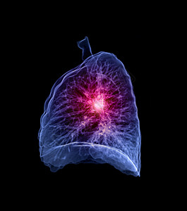 CT 肺3d 肝脏成象诊断结节断层医院电脑结核疾病肋骨解剖学病人图片