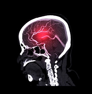 CTA 脑部或CT 脑血管成像 剖面观察 医学技术概念图片