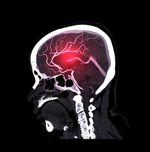 CTA 脑部或CT 脑血管成像 剖面观察 医学技术概念图片
