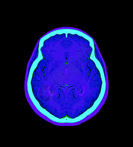 脑部或CTA大脑轴心 科罗纳尔和地表视图的CT血管成像色彩多彩图片