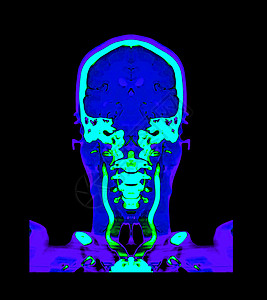 收集了脑部CT血管成像或CTA大脑对比的多彩图象 以比较科隆视图放射科ct医院药品科学动脉瘤诊断扫描仪脑血管扫描图片