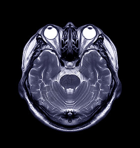 大脑核磁共振药品射线诊断颅骨血管病人出血中风谐振动脉图片
