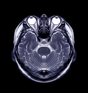 大脑核磁共振药品射线诊断颅骨血管病人出血中风谐振动脉图片