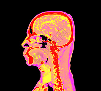大脑或 CTA 脑部成像图的多彩色彩 缩放路径放射科手术疾病辐射医疗器材背景脑血管医院解剖学图片