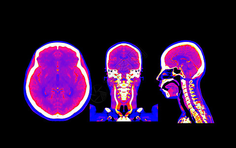 收集了脑部CT血管成像或CTA大脑对比的多色图象 以比较轴向 科罗纳尔和司格特视图图片