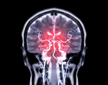 核磁共振脑骨质T2W和MRA脑聚变 在科隆的视野头晕疾病困惑医院弱点病人动脉大脑扫描射线图片