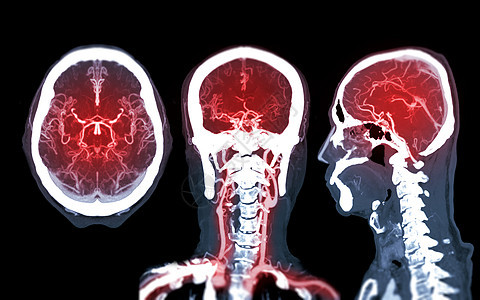 收集CTA大脑或CT脑血管学 比较Mip Axial Conronal和Sagitatal视图的大脑对比 以探测脑动脉图片