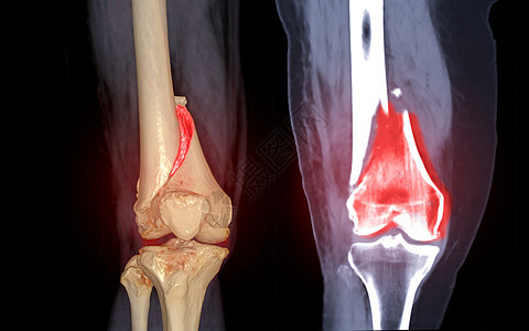 CT 膝关节 3D 渲染图像前视图和冠状视图隔离在黑色背景上 显示股骨骨折图片