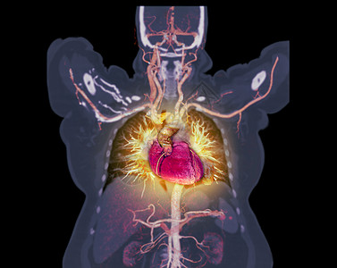 CTA 冠动脉 胸腔显示心血管系统器官男性主动脉心室生物学插图心肌科学流量疾病图片