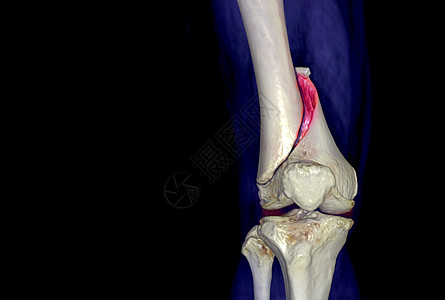 CCT膝盖 3D 让图像AP视线被孤立 在黑色背景上显示骨折 Femur骨骼骨折考试医院教育射线技术科学软骨症状事故扫描图片