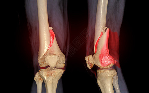 CCT膝盖 3D 拍摄成像AP和侧面视图 在黑色背景上孤立 显示骨折 Femur骨骼骨折图片