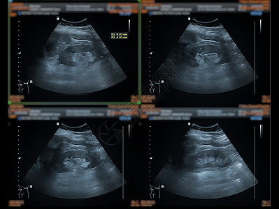上腹部超声波检查显示肝脏 胆囊和肾 以筛查腹部疾病膀胱小腹药品放射科脓肿诊断考试检查异质身体图片