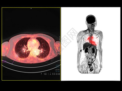 胸部CTPET 为检测肺癌复发而比较轴心 冠状腺的胸部或胸部扫描图像背景