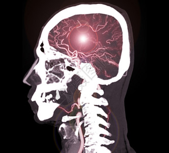 脑部CT血管成像或CTA大脑剖面视图的多彩色彩图片