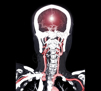 脑部或CTA大脑科隆视图的CT血管造影多彩图片