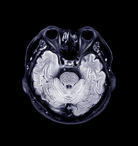 大脑核磁共振药品医院疾病诊断射线放射科出血头晕中风血管图片