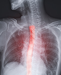 Esophagram或Bior 燕子图像显示病人对于Esopageal癌症的治疗图片