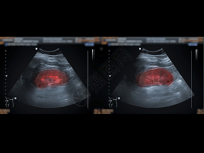 超声波上腹部显示肾脏用于肾脏疾病筛查图片