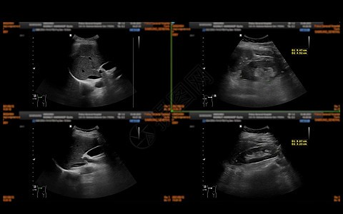 上腹部超声波检查显示肝脏 胆囊和肾 以筛查腹部疾病肝炎异质脓肿药品检查怀孕考试感染膀胱回声图片