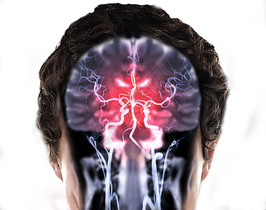 核磁共振脑骨质T2W和MRA脑聚变 在科隆的视野病人中风颅骨疾病困惑医院谐振血管照相诊断图片
