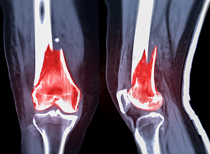 ct室骨骼骨折的黑色背景中 被隔离在Coronal和Sagitatal两侧背景