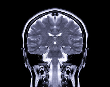 核磁共振脑 Coronal t2W 查看以探测大脑的各种状况 如细胞 肿瘤 屏幕上隔离的出血等图片