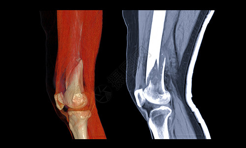 比较CT膝盖关节3D成像横向视图和在黑色背景上孤立的外观显示骨折Femur骨折图片
