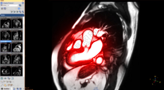 MRI 心脏或心脏 MRI 磁共振成像在矢状视图中显示左心室和右心室的横截面 用于在模糊的监视器上检测心脏病图片