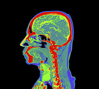 大脑或 CTA 脑部成像图的多彩色彩 缩放路径背景药品动脉解剖学谐振医院脑血管疾病外科辐射图片