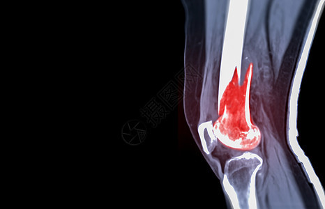 CCT膝盖 3D 将图像的横向视图 孤立在黑色背景上 显示骨折Femur骨骼骨折科学药品末端病人腓骨胫骨扫描器症状疼痛股骨图片