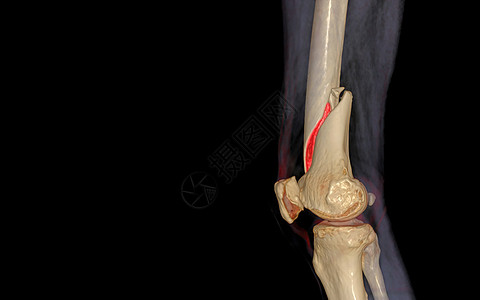 CCT膝盖 3D 将图像的横向视图 孤立在黑色背景上 显示骨折Femur骨骼骨折射线腓骨膝伤症状教育科学病人胫骨放射科骨科图片
